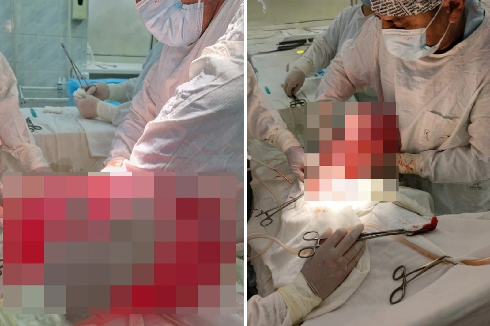 В Кумертау спасли мужчину с заворотом кишки на 360 градусов